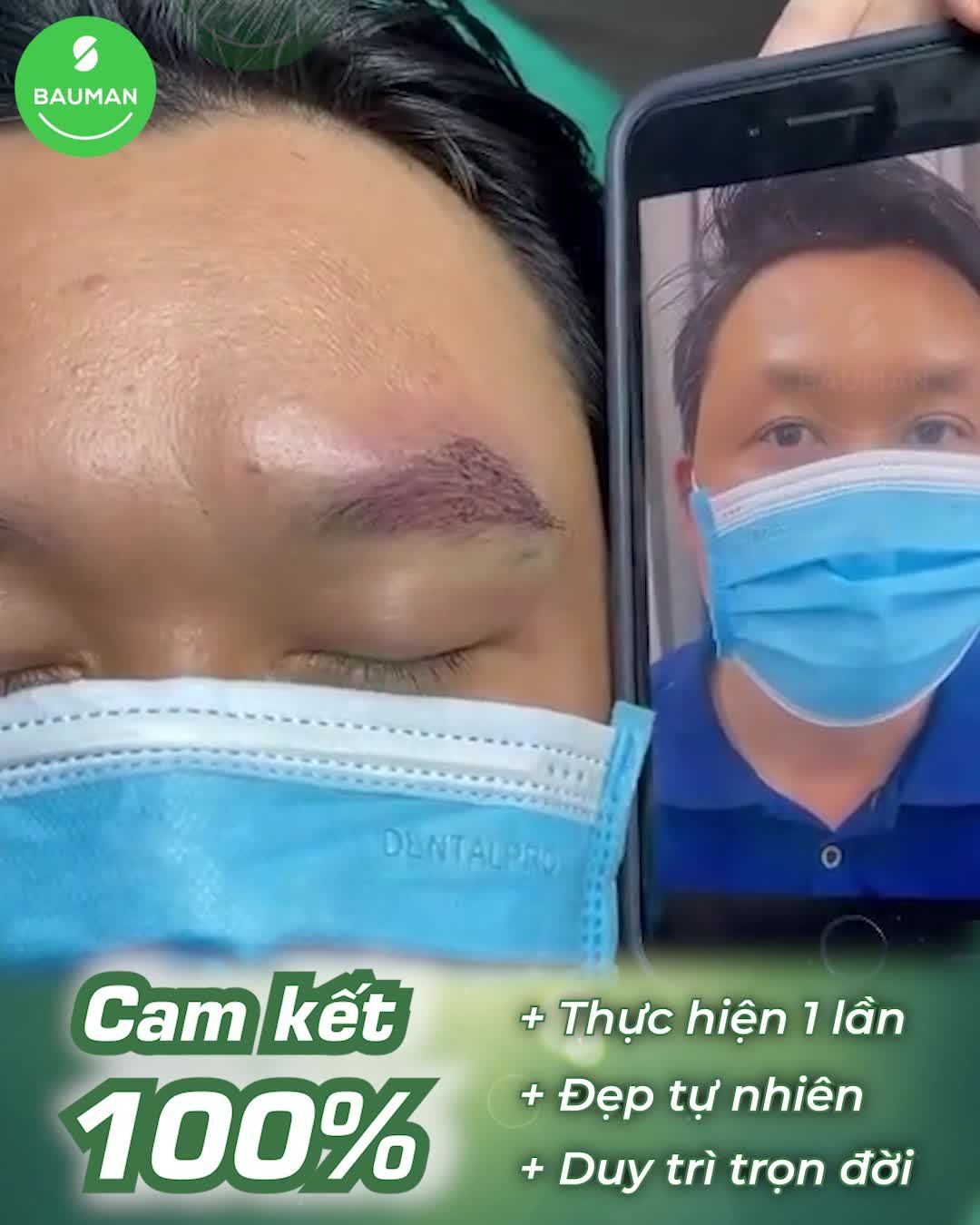 Ngay sau cấy lông mày tự thân nam giới (phần 1)