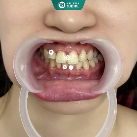 Làm răng sứ xong ăn nhai được luôn không?