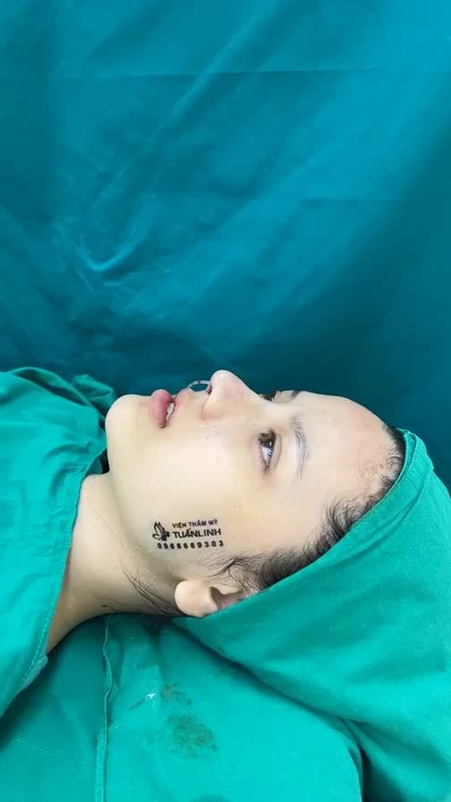 Case mũi cấu trúc bóc chỉ vừa hoàn thành