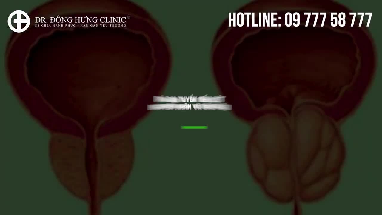 PHÌ ĐẠI TUYẾN TIỀN LIỆT, NGUYÊN NHÂN VÀ DẤU HIỆU -  ĐÔNG HƯNG