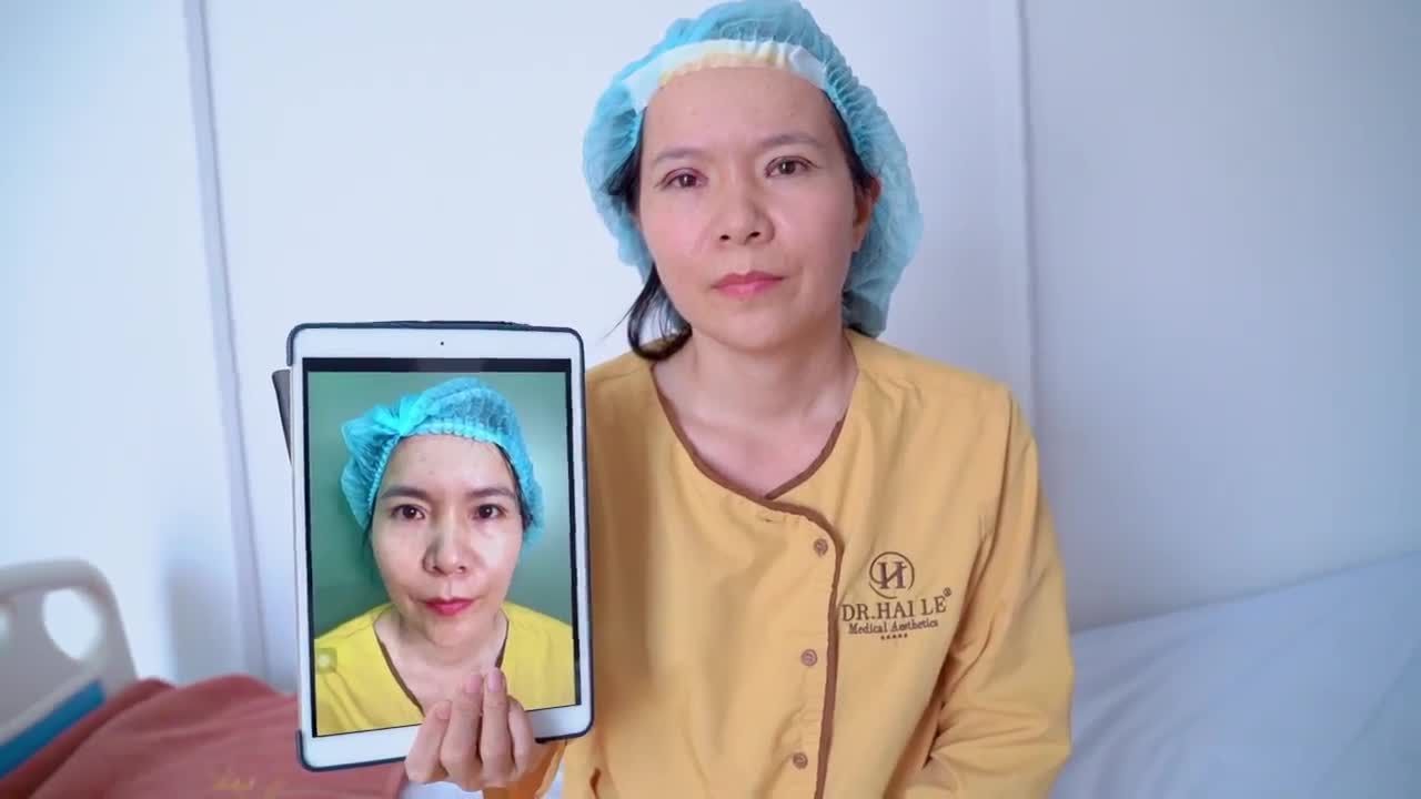 Đây là lý do khách hàng khu vực phía nam chọn Dr.Hải Lê cơ sở HCM sửa lại mí lỗi hỏng đây ạ