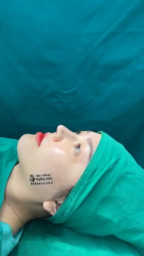 Case mũi cấu trúc vừa hoàn thành
