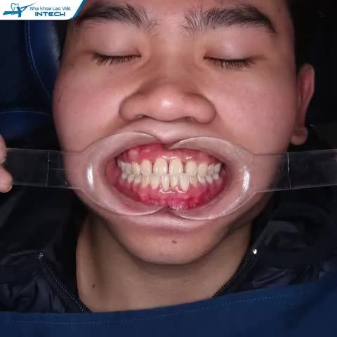 RĂNG THƯA - KHỚP CẮN CHÉO ĐIỀU TRỊ NHƯ THẾ NÀO?