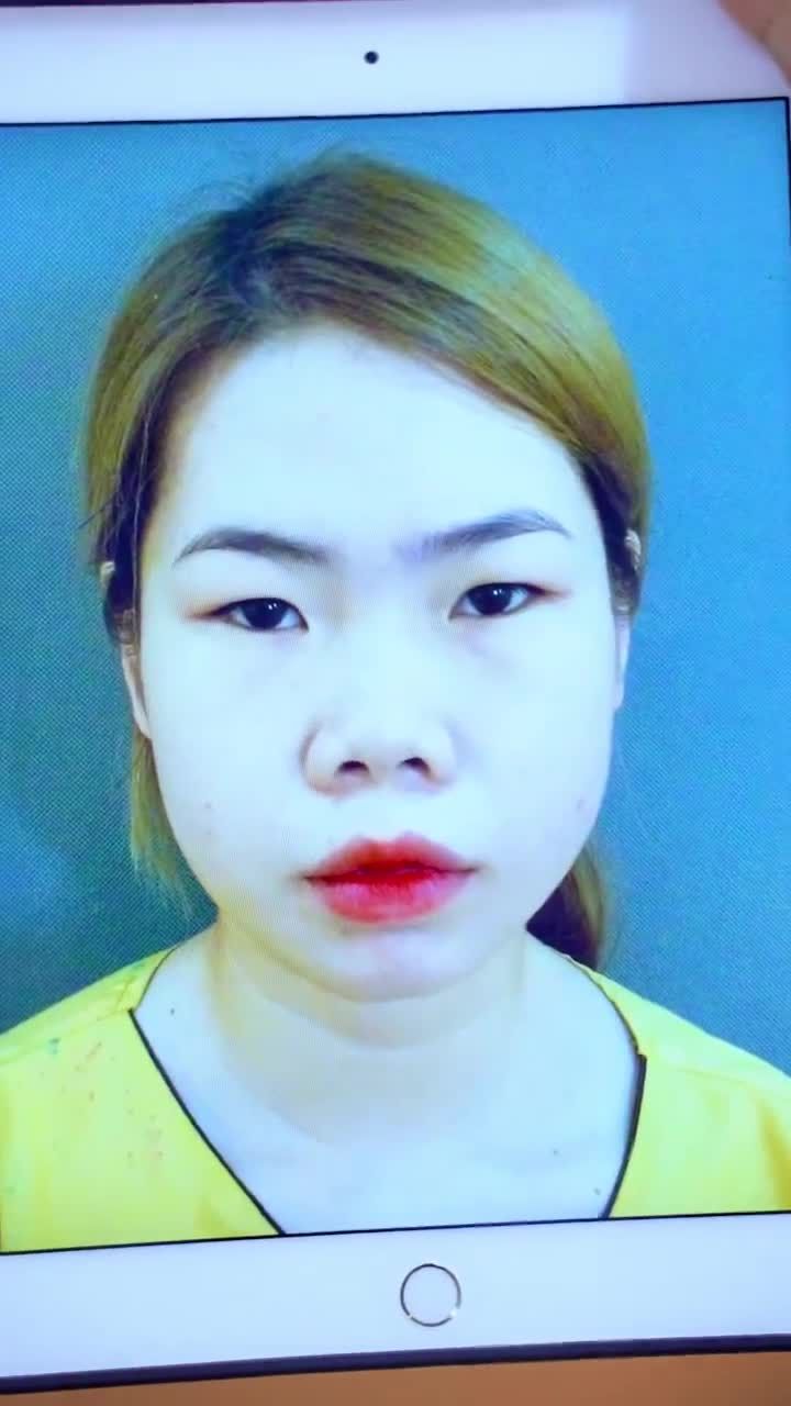 Mắt 1 mí + mũi thấp tẹt được Dr.Hải Lê khắc phục thành công như thế nào? Cả nhà cùng đón xem