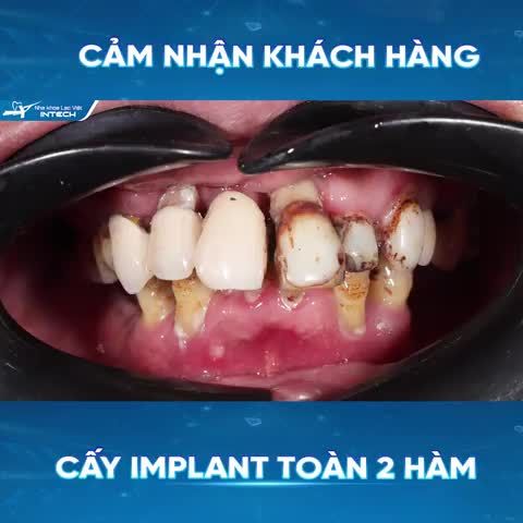 CẤY IMPLANT TOÀN 2 HÀM  - YÊN TÂM ĂN UỐNG, TẬN HƯỞNG TUỔI GIÀ