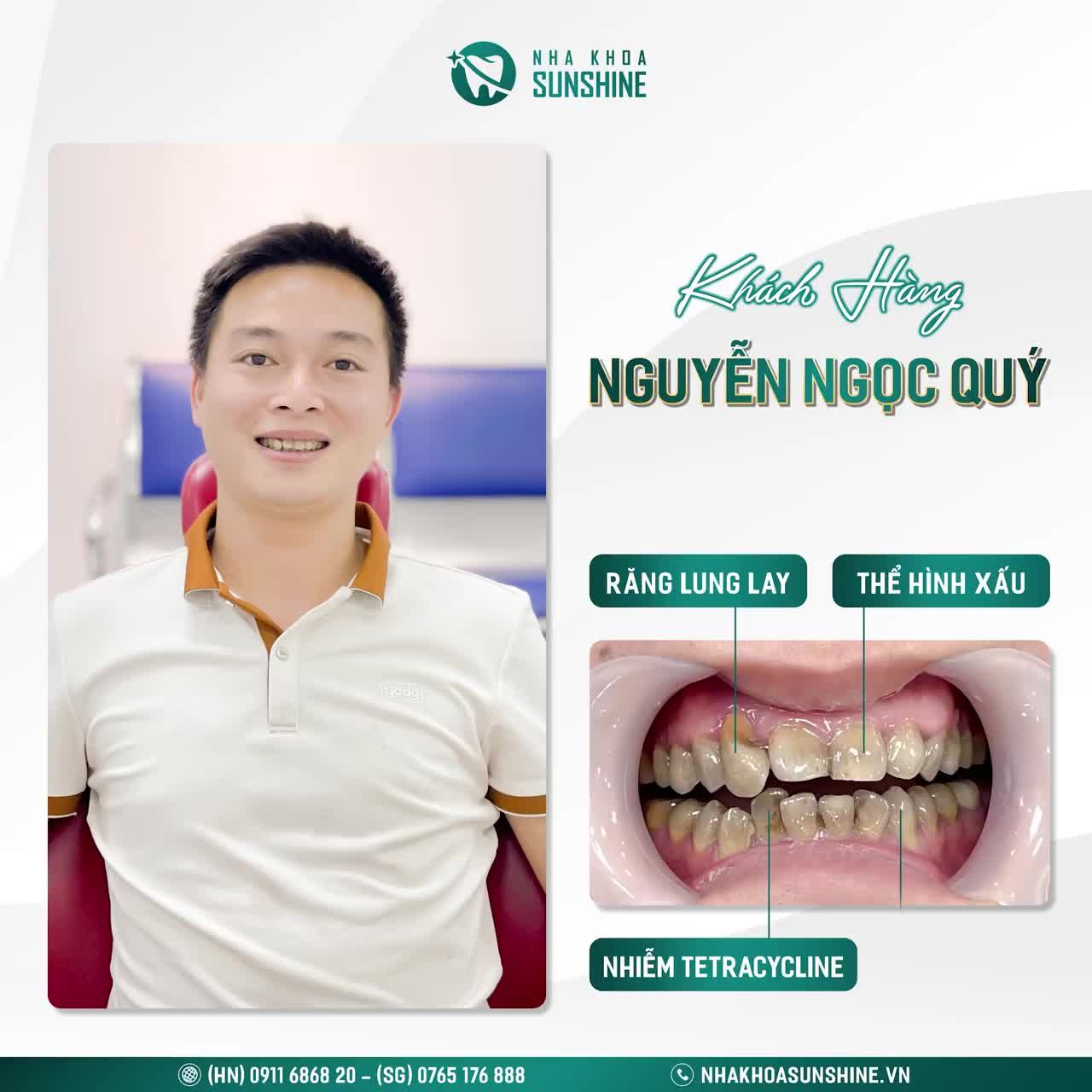 Cùng xem 48H khắc phục tình trạng này cho anh khách hàng NGUYỄN NGỌC QUÝ tại Sunshine nhé.