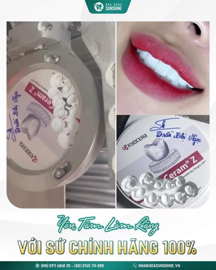 An tâm về dòng răng sứ mình chọn sẽ không bị tráo/đổi trong thời gian chế tác mão sứ.