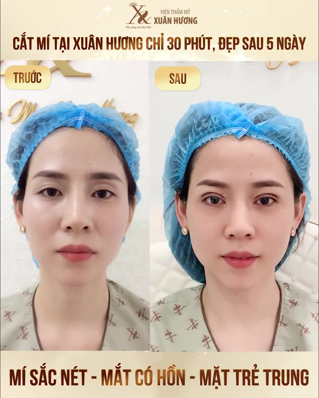 KỸ THUẬT CẮT MÍ TRÊN DƯỚI DIỆN RỘNG HIỆU QUẢ VƯỢT TRỘI TẠI XUÂN HƯƠNG