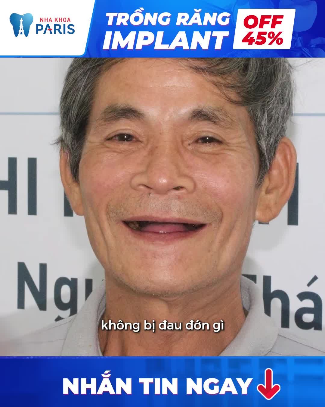HÉ LỘ ĐỊA CHỈ TRỒNG RĂNG UY TÍN