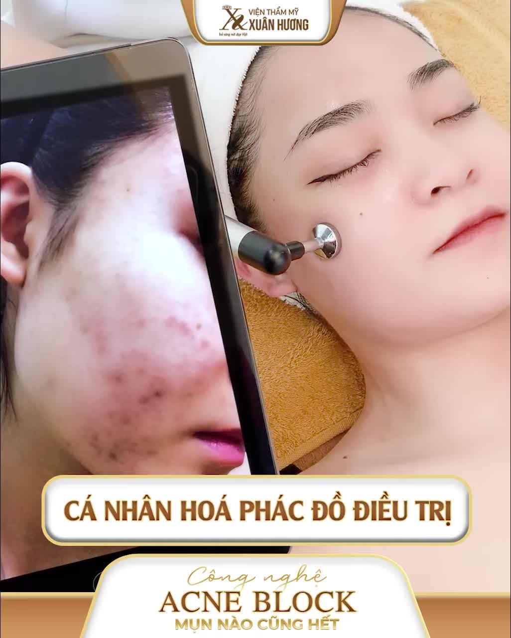 MỤN - KẺ THÙ CỦA LÀN DA MÙA HÈ