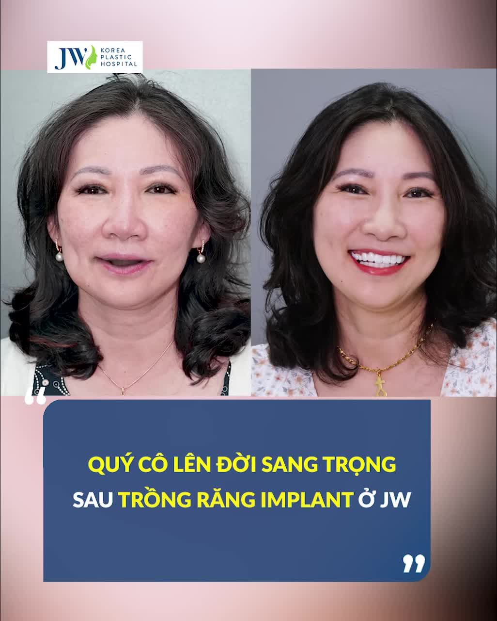 Nữ DOANH NHÂN U60 chi 100 Triệu làm Răng Implant, hóa NGƯỜI ĐẸP không tuổi.