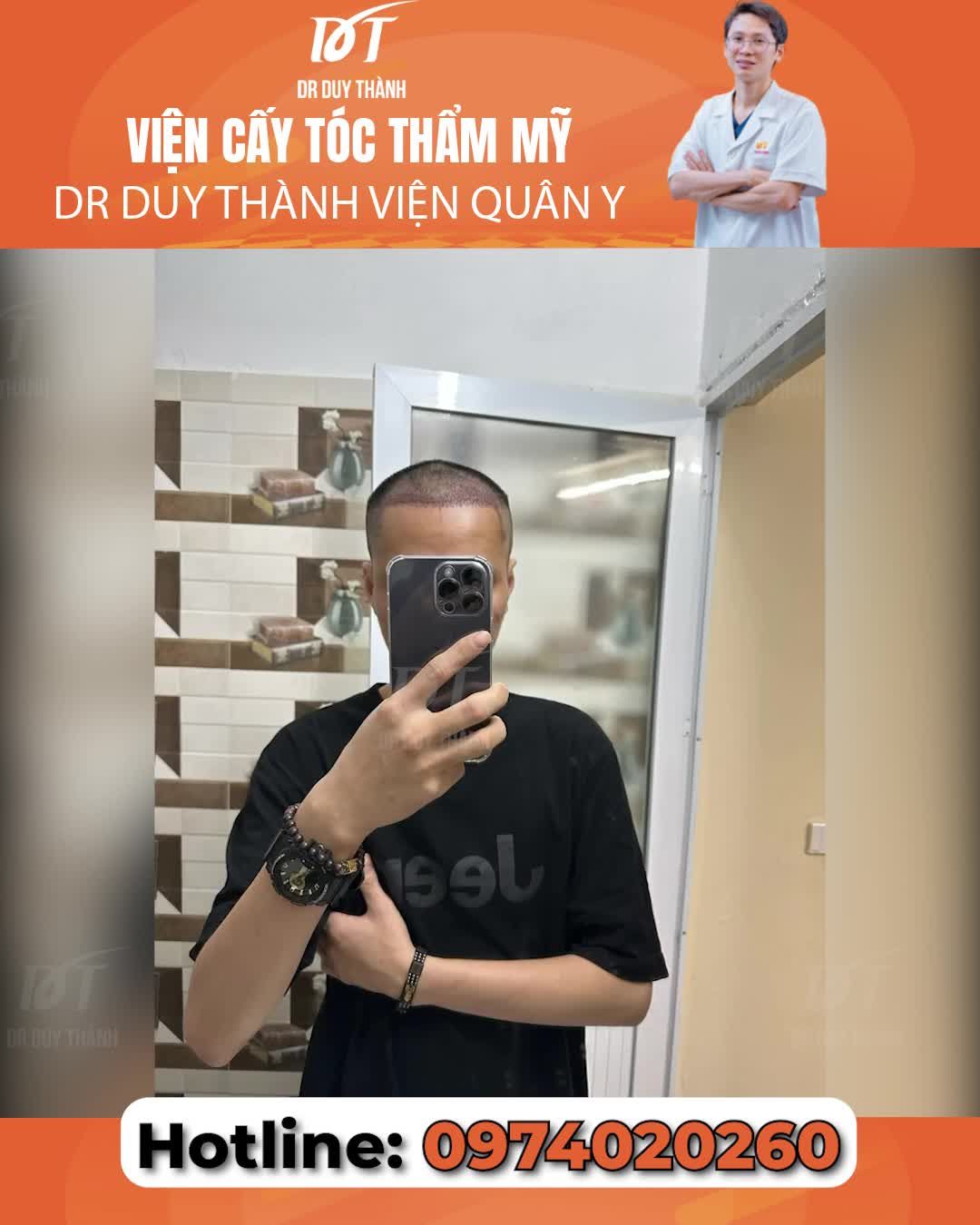 Chi tiết hành trình cấy tóc từ ngày 1 đến tháng thứ 5