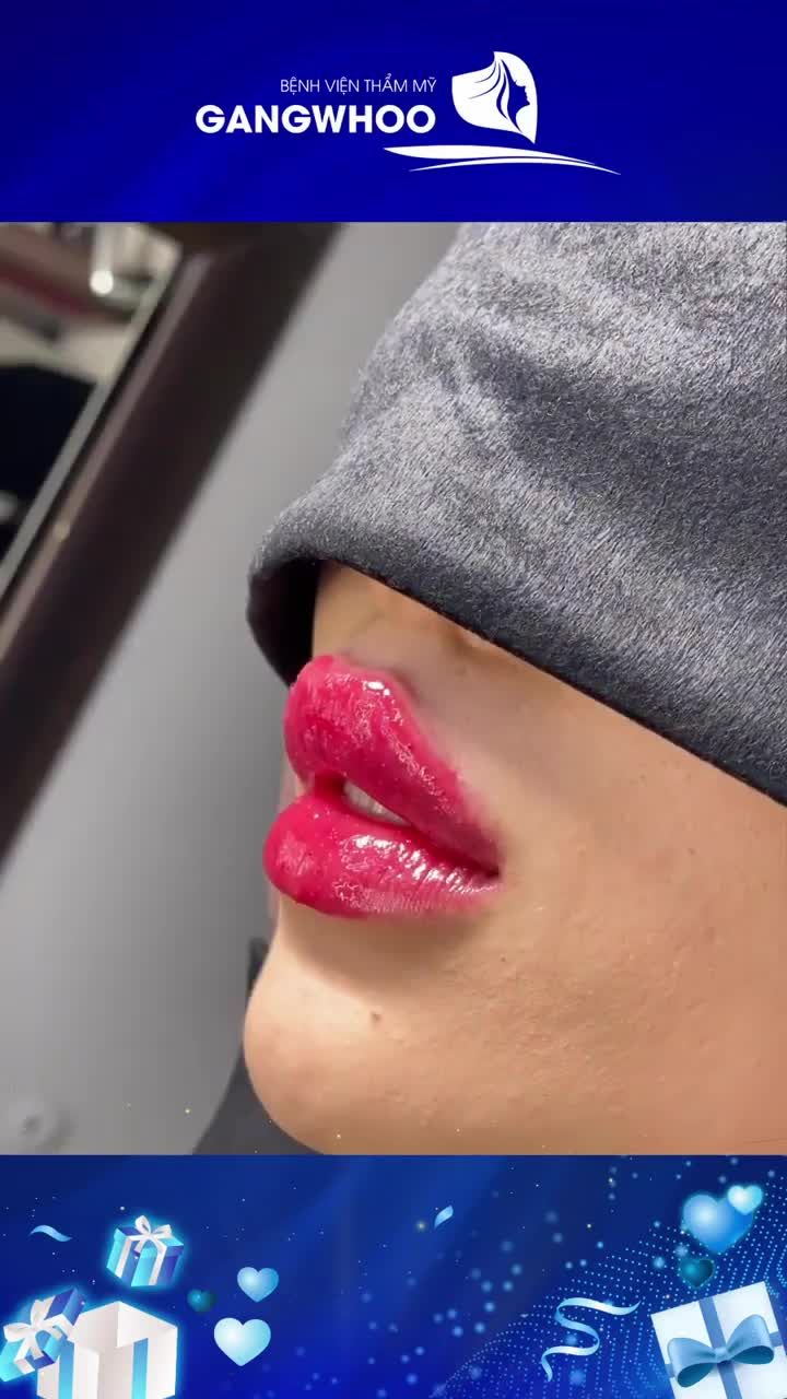 NHỮNG ĐIỀU CẦN BIẾT VỀ TIÊM MÔI CHO BẠN GÁI