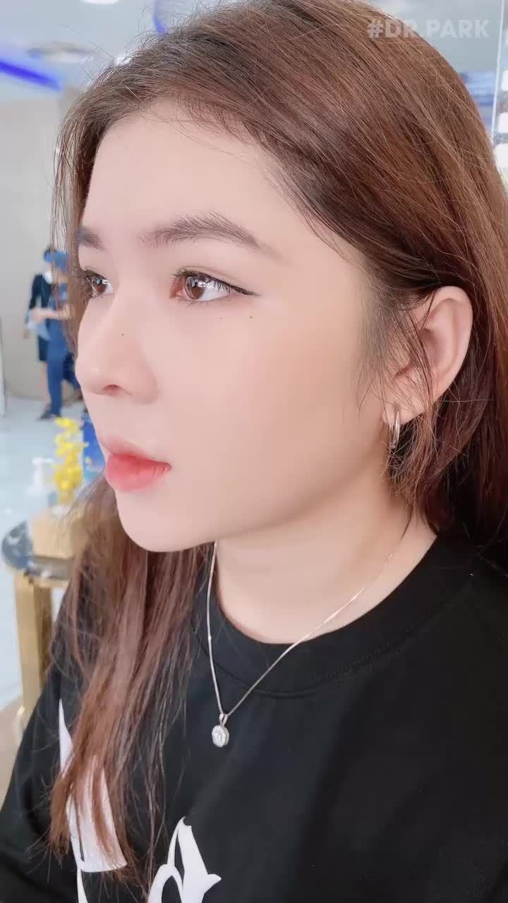 ƯU ĐIỂM NỔI BẬT CỦA NÂNG MŨI BỌC SỤN TAI?