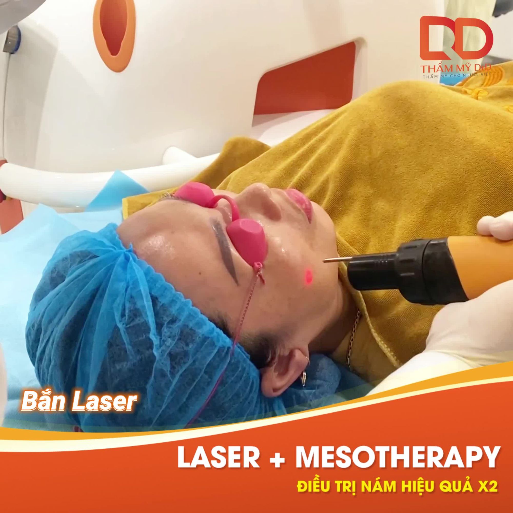LASER + MESOTHERAPY ĐIỀU TRỊ NÁM HIỆU QUẢ GẤP 2 LẦN