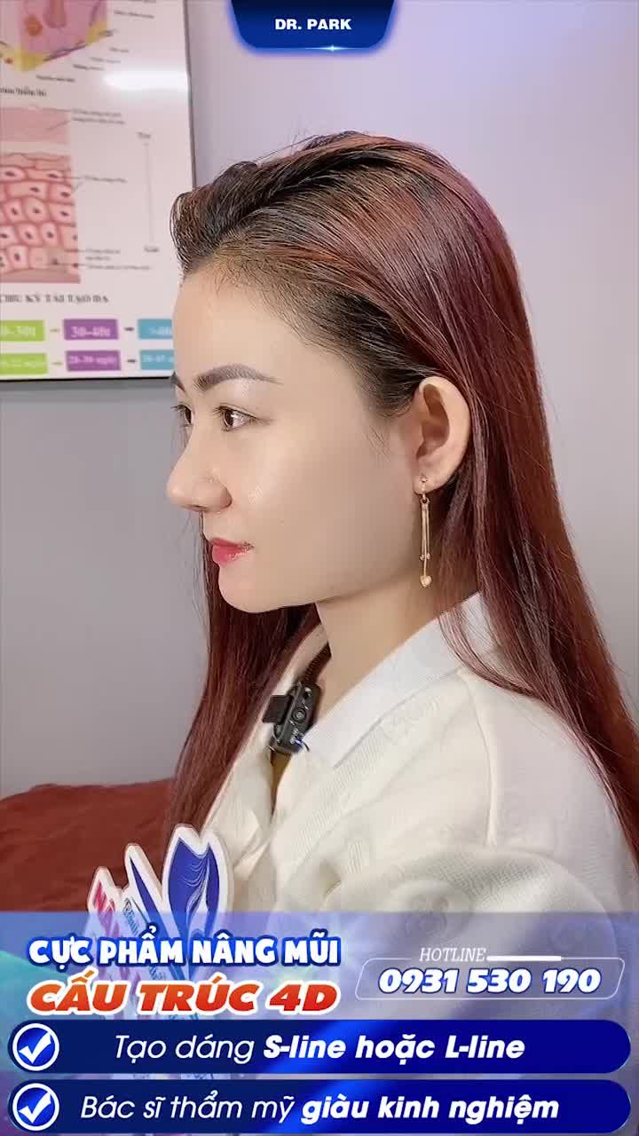 NÂNG MŨI CẤU TRÚC KHÁC GÌ SO VỚI CÁC PHƯƠNG PHÁP NÂNG MŨI KHÁC