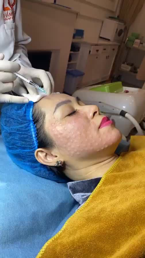 Tiêm Mesotherapy trị nám khác so với tiêm Mesotherapy trẻ hoá, căng bóng, trắng hồng da không nhỉ?