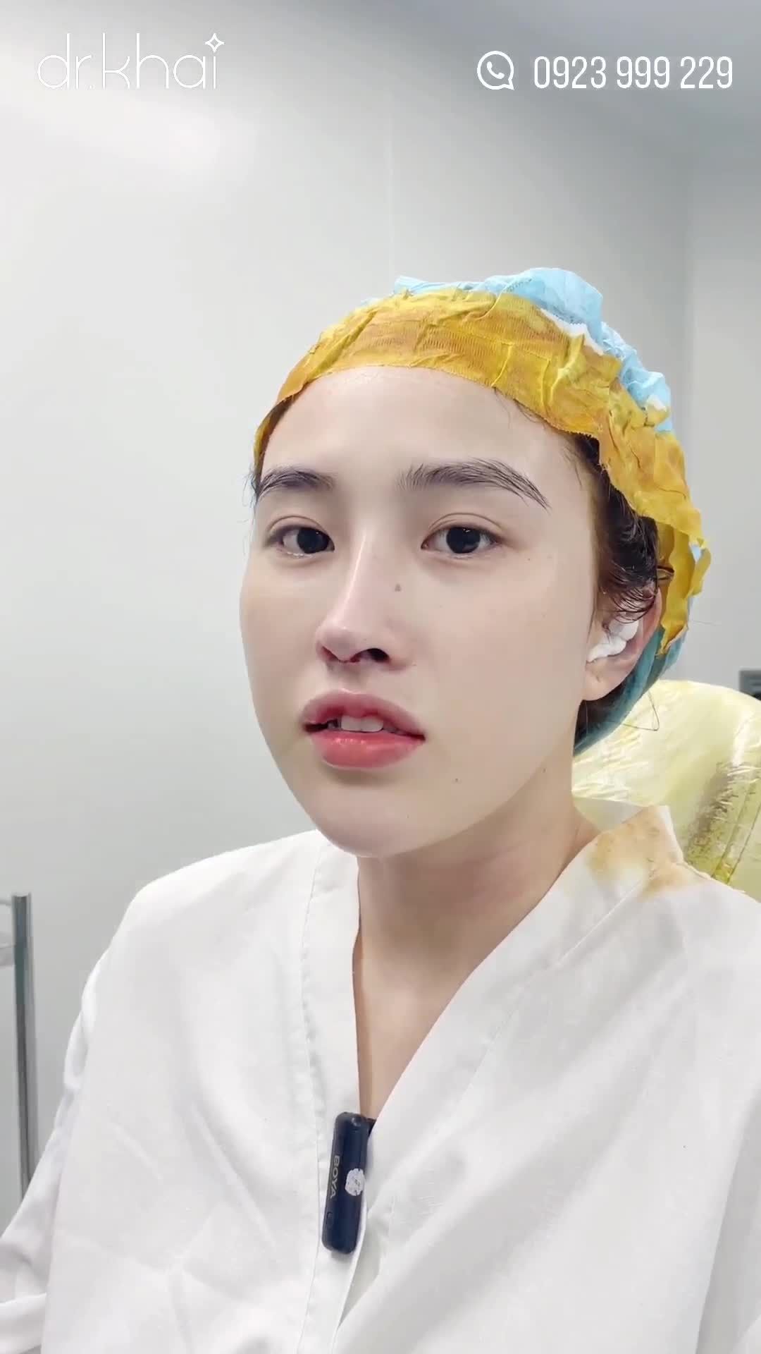 NÂNG MŨI CẤU TRÚC SỬA LẠI DO MŨI ĐÃ TỪNG NÂNG BỊ LỘ SÓNG