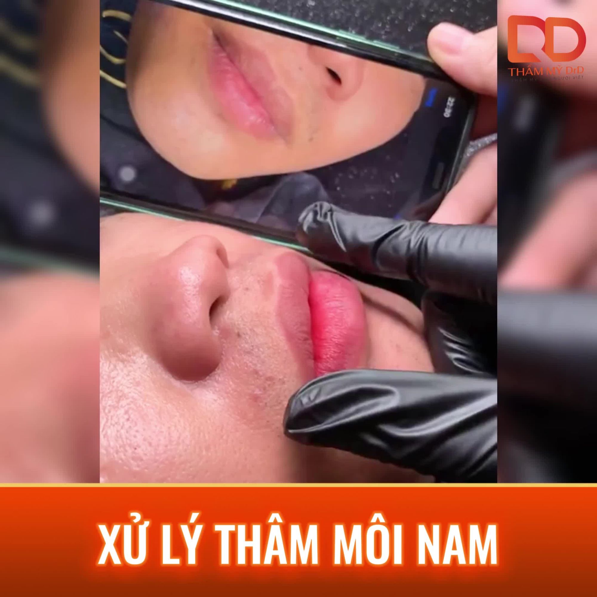 XỬ LÝ MÔI THÂM NAM GIỚI CÓ HIỆU QUẢ KHÔNG?