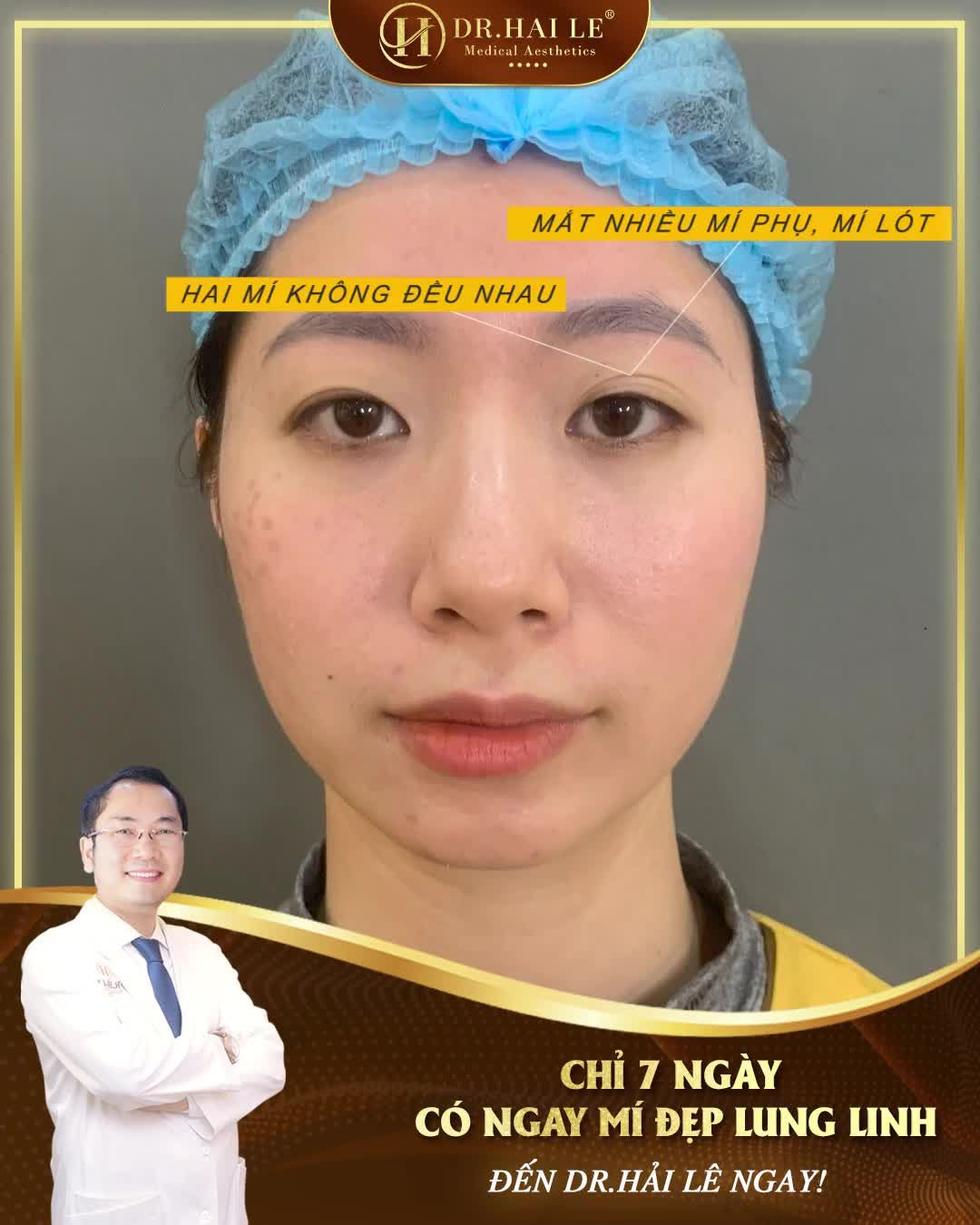 Đôi mắt 2 mí sắc đẹp tự nhiên chỉ sau 7 NGÀY, bạn có tin được không?