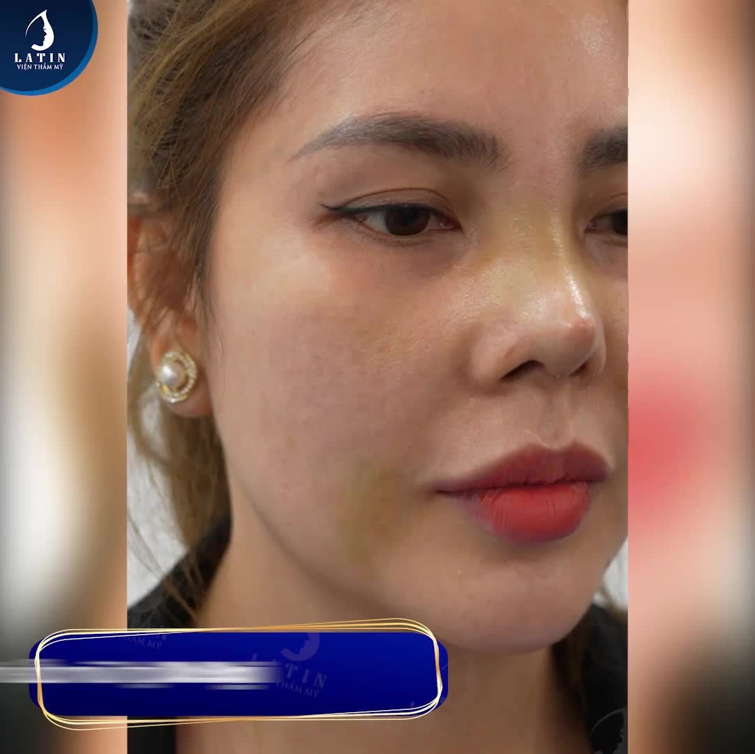 Cái kết hạnh phúc cho hành trình sửa lại dáng mũi của chị khách hàng.