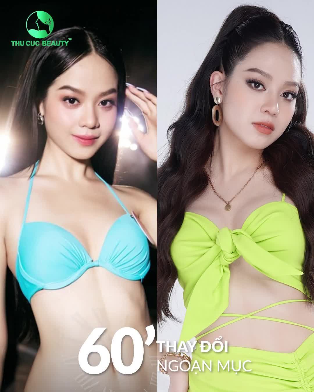 Nâng ngực TC - Nâng là ĐẸP