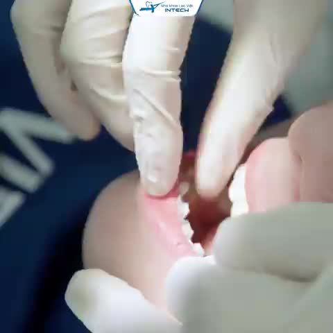 KHẮC PHỤC HOÀN TOÀN TÌNH TRẠNG KHẤP KHỂNH - KHỚP CẮN HỞ SAU 2 NĂM NIỀNG RĂNG CÔNG NGHỆ X-MATRIX
