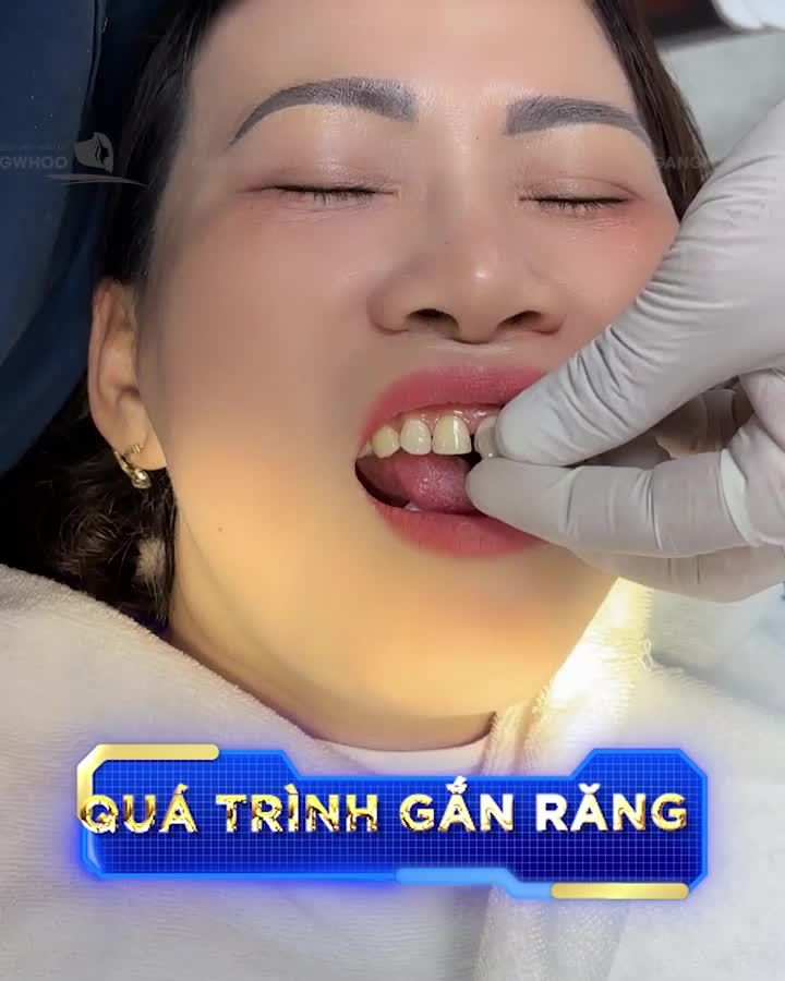 DÁN SỨ VENEER KHÔNG MÀI - SỞ HỮU NỤ CƯỜI HOÀN HẢO - LẤY LẠI 10 NĂM THANH XUÂN