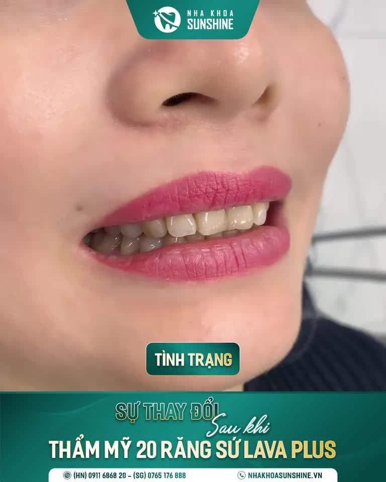 Còn gì tuyệt vời hơn khi sở hữu một nụ cười thu hút.