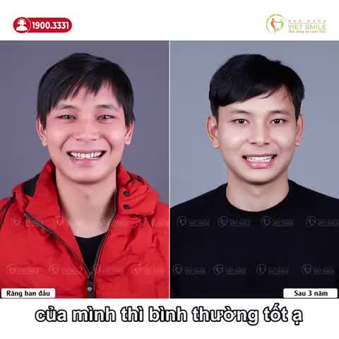 RĂNG SỨ KHỎE ĐẸP, MÀU TỰ NHIÊN SAU 3 NĂM