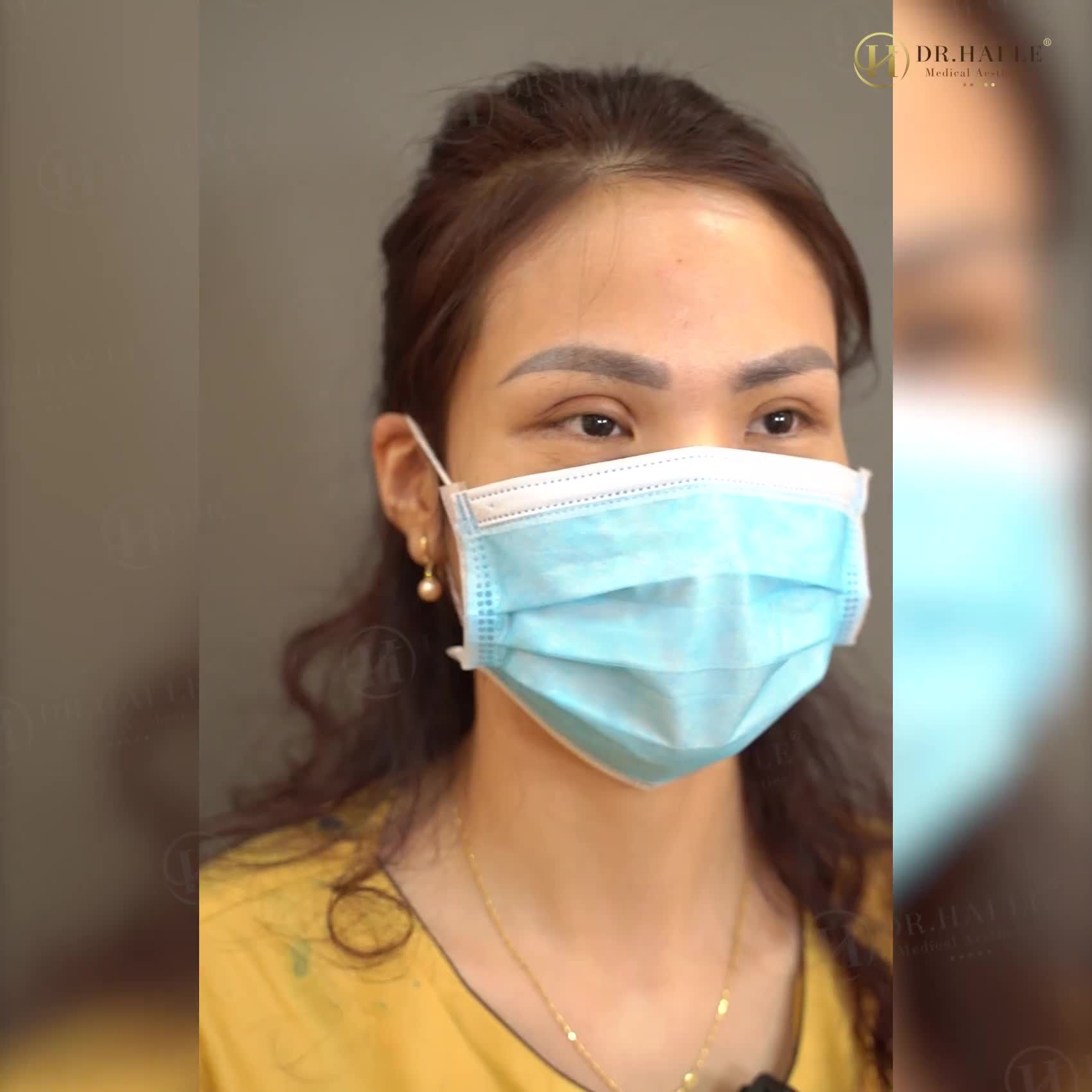 Quyết tâm đến Dr.Hải Lê sửa mí lỗi, vị khách hàng có cảm nhận như thế nào về sự thay đổi của đôi mắt?