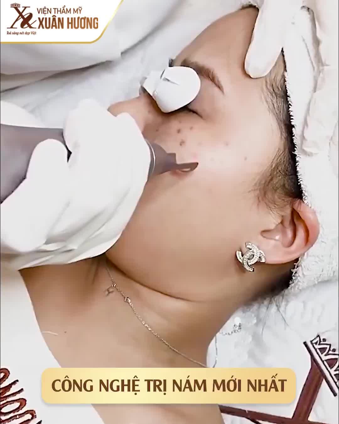 XÓA NÁM THÌ PHẢI SỬ DỤNG CÔNG NGHỆ HIỆN ĐẠI NHƯ THẾ NÀY
