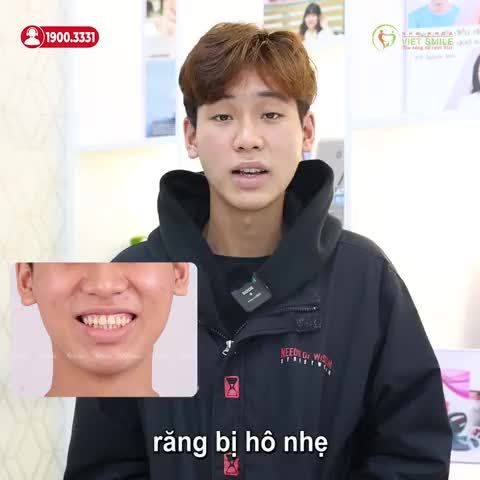NIỀNG RĂNG HÔ VỚI MẮC CÀI KIM LOẠI