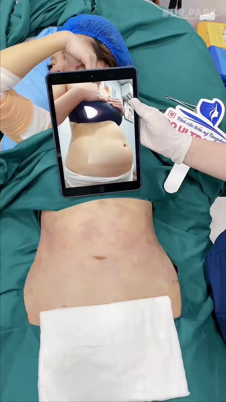 CÔNG NGHỆ LIPO ULTRASOUND - CÔNG NGHỆ HÚT MỠ AN TOÀN