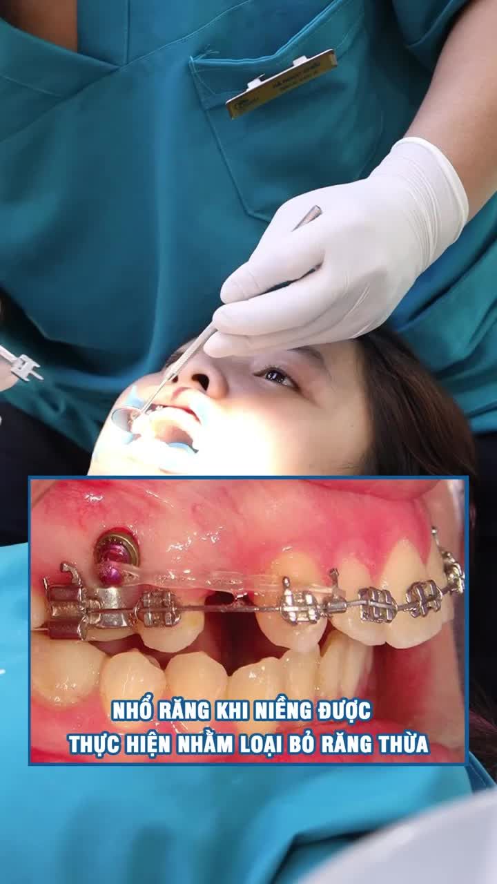 Niềng răng khểnh có phải nhổ răng không?