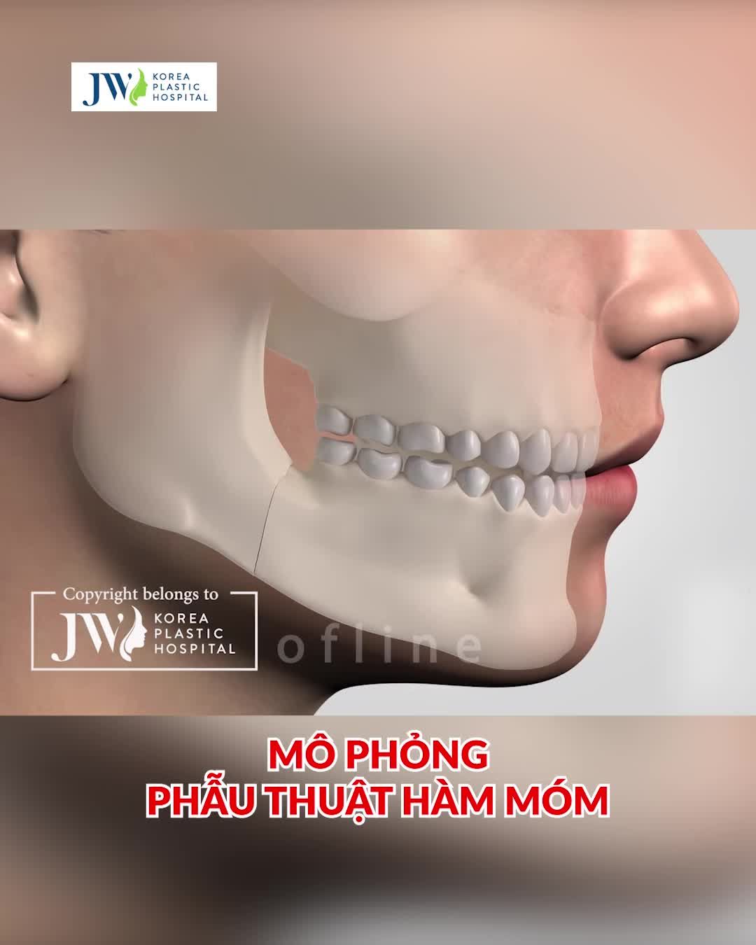 PHẪU THUẬT HÀM MÓM - LỘT XÁC HOÀN HẢO, NHAN SẮC ĐỈNH CAO