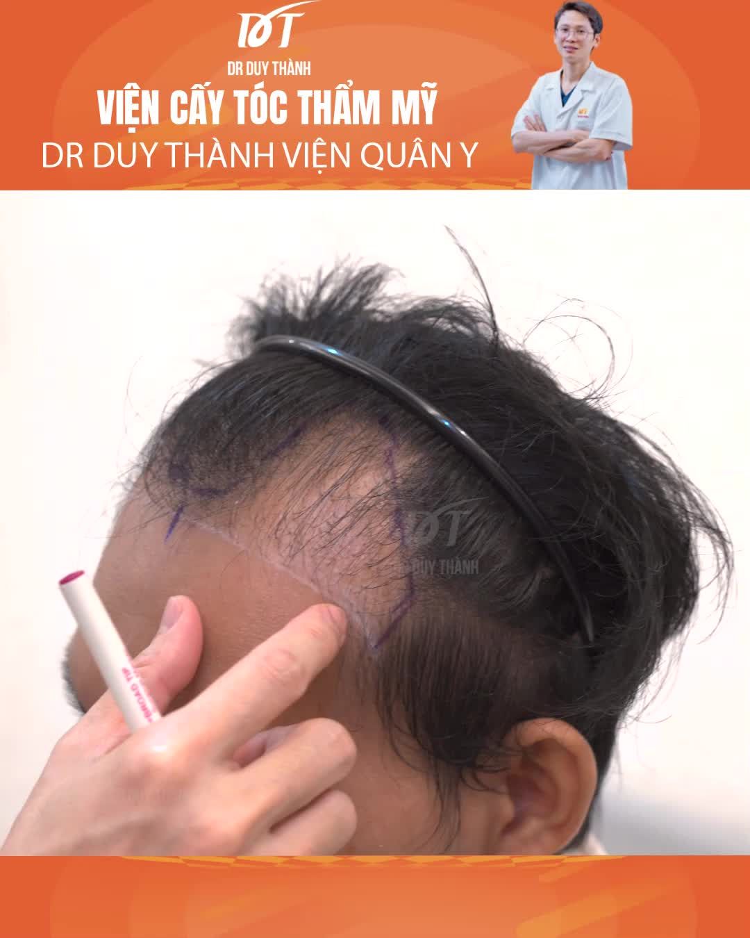 Dr Duy Thành chỉnh sửa ca cấy tóc hỏng lỗi từ Hàn Quốc