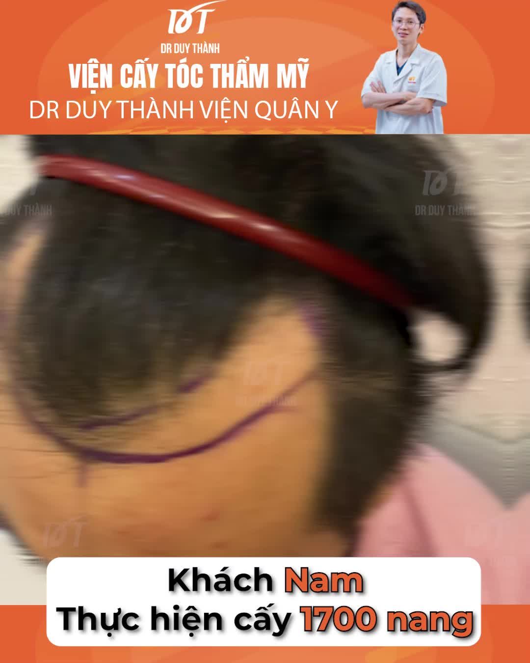 Cấy 1700 nang tóc phủ khuyết chữ M, khách nam 35 tuổi Nha Trang
