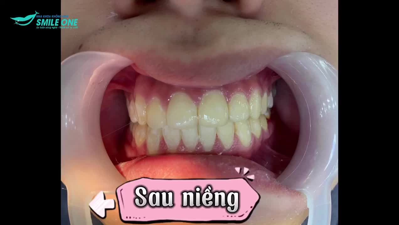 Thay đổi giao diện với nụ cười tươi sáng hơn!