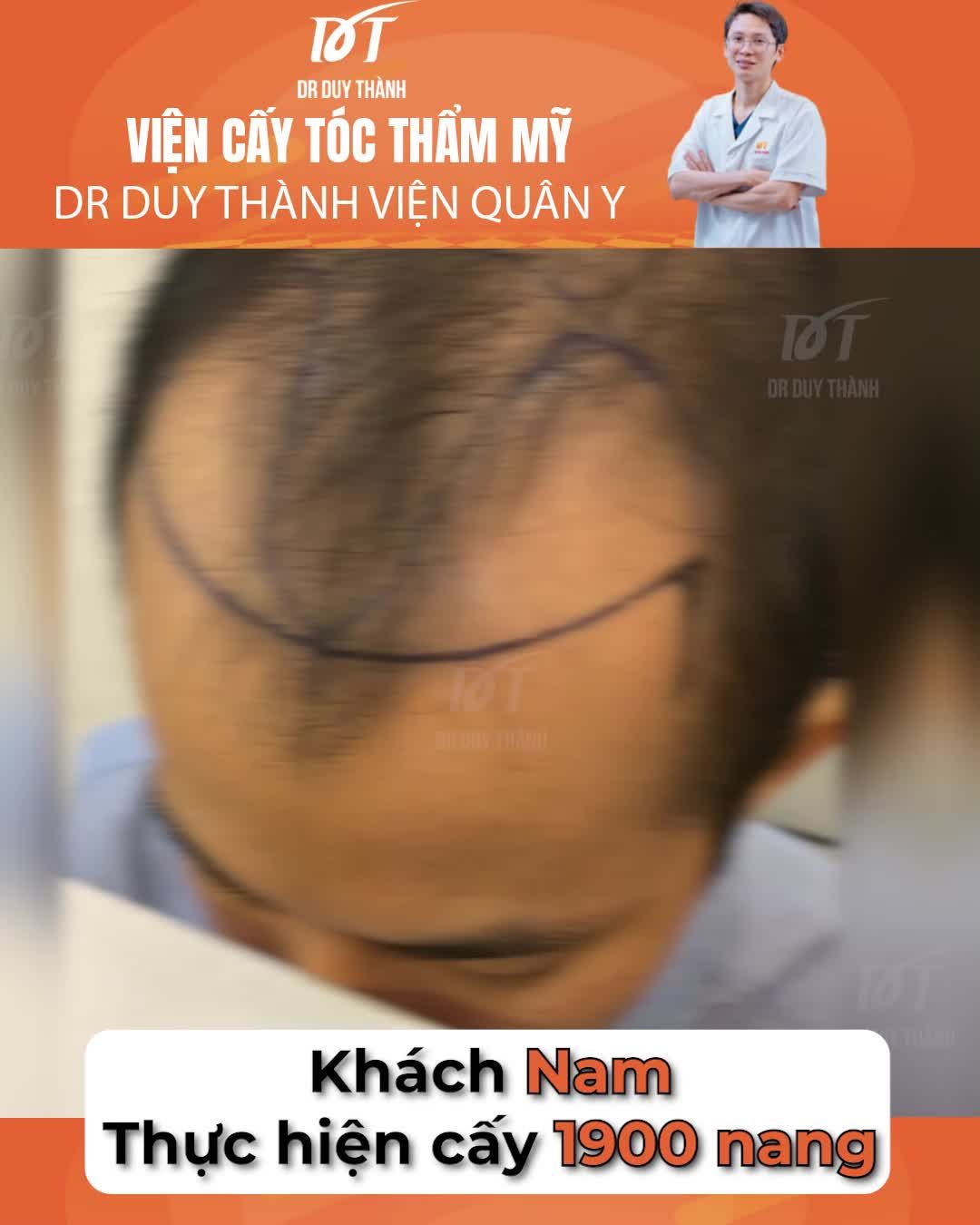 Thoát hói thần kỳ sau cấy 1900 nang tóc, khách nam 30 tuổi Vũng Tàu