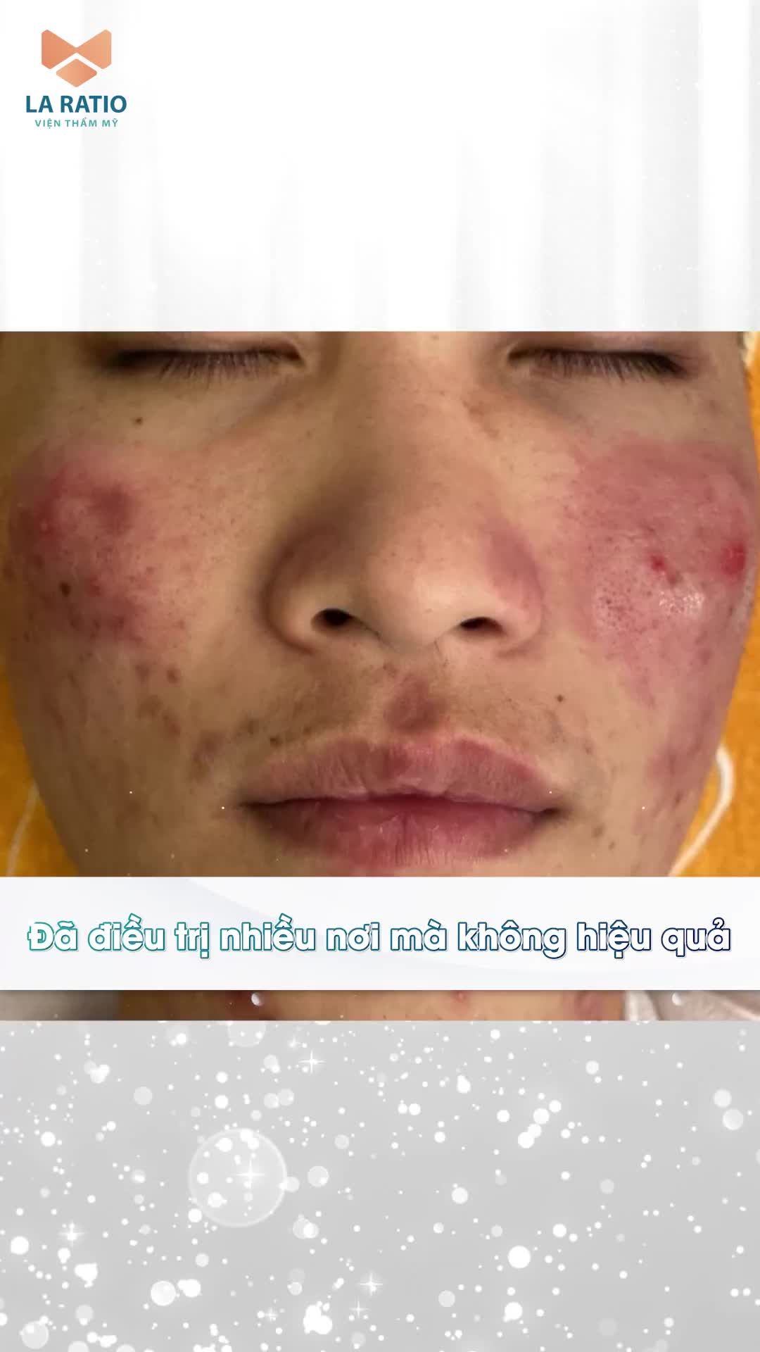 PCARE - HIỆU QUẢ TRỊ MỤN NGAY LẦN ĐẦU THỰC HIỆN
