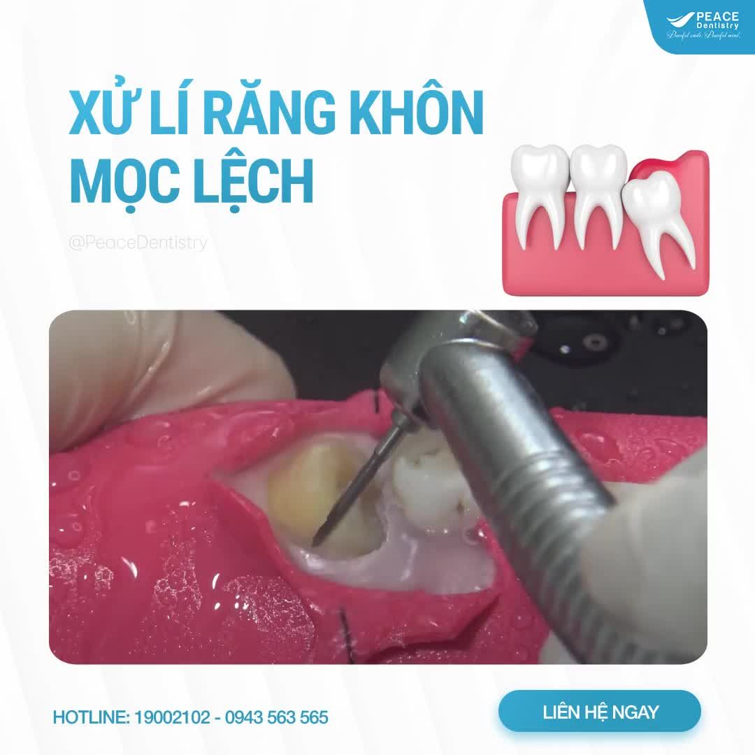 RĂNG KHÔN MỌC NGẦM, MỌC LỆCH: NHỮNG ĐIỀU BẠN NÊN BIẾT SỚM!