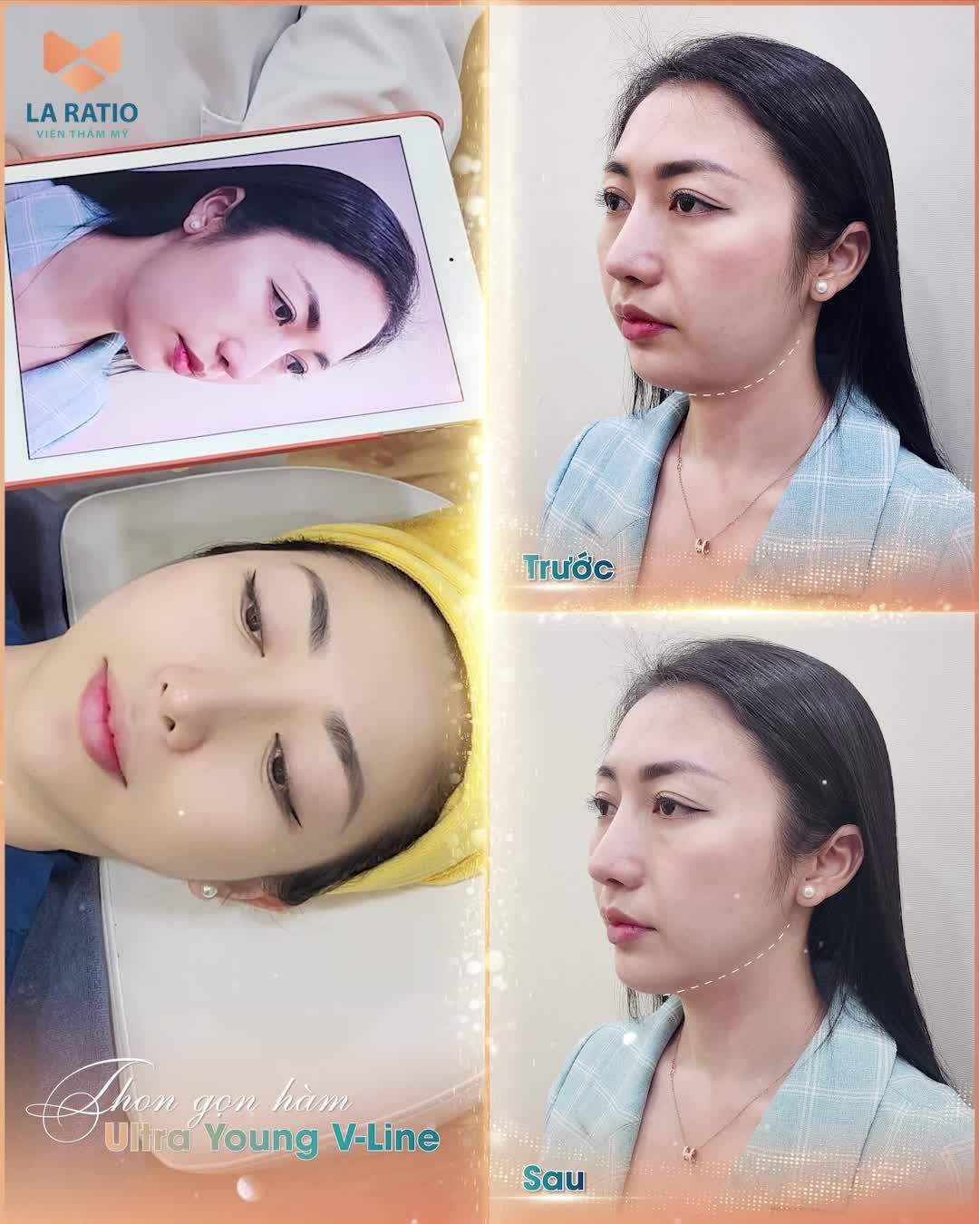 THON GỌN GÓC HÀM SẼ BIẾN ĐỔI GƯƠNG MẶT RA SAO?