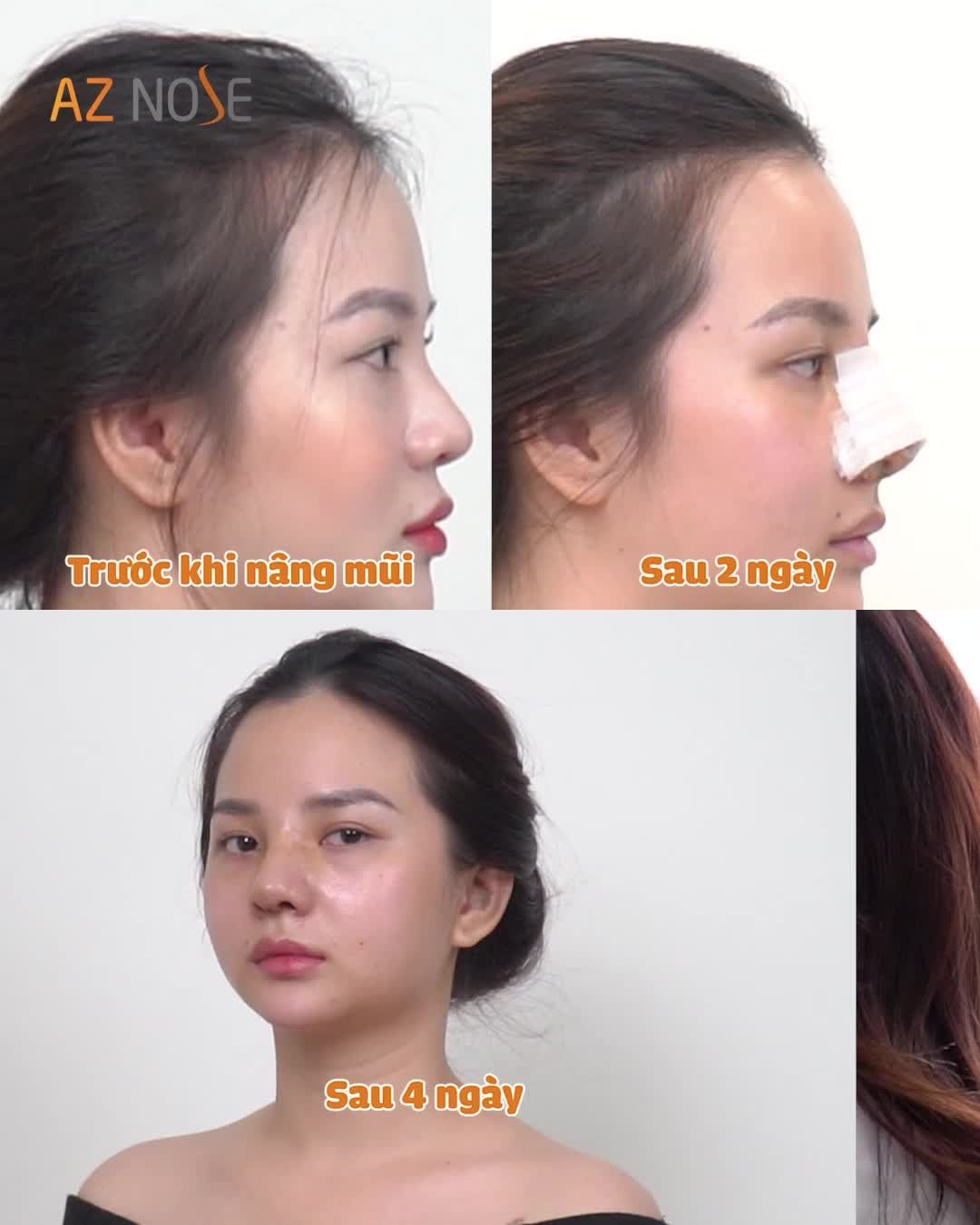 Dáng mũi vào form thế nào sau 1 tháng phẫu thuật