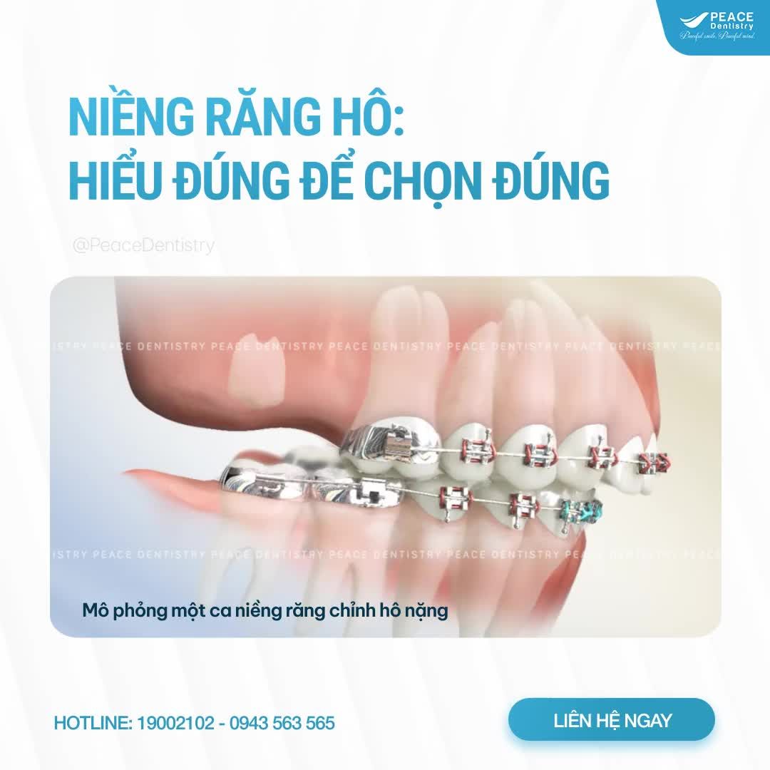 NIỀNG RĂNG HÔ GIẢI ĐÁP 6 CÂU HỎI PHỔ BIẾN