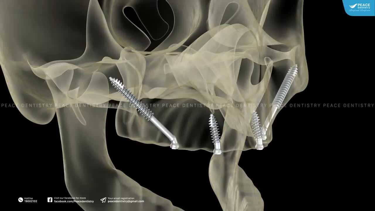 CẤY GHÉP IMPLANT XƯƠNG GÒ MÁ (?????? ???????)