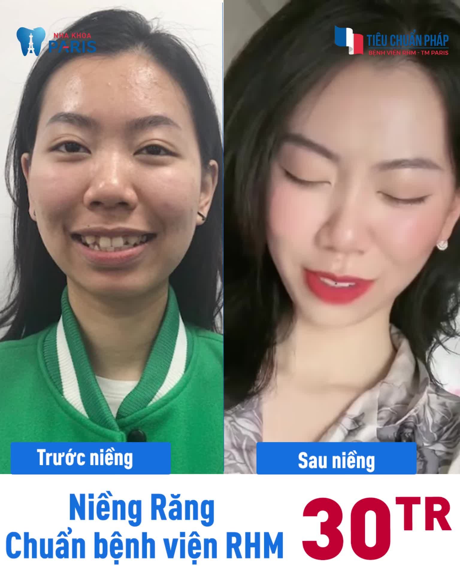 Niềng Răng Có Ngay Nụ Cười Hài Hòa, Cân Đối