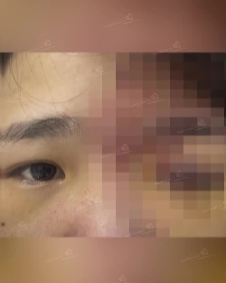 Tiêm Filler hiện đang là phương pháp làm đẹp không cần phẫu thuật được rất nhiều chị em ưa chuộng và lựa chọn.