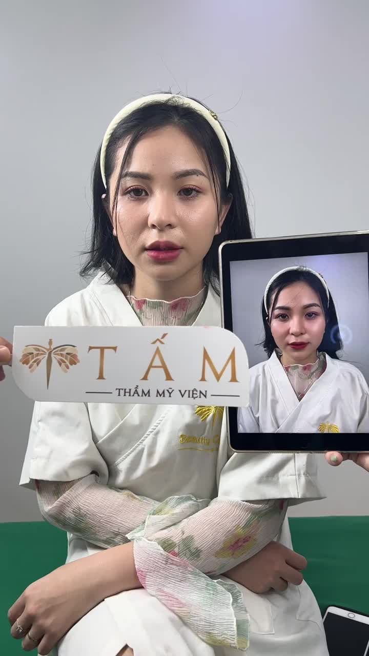 Ca Filler môi tại phòng khám TMV Tấm.