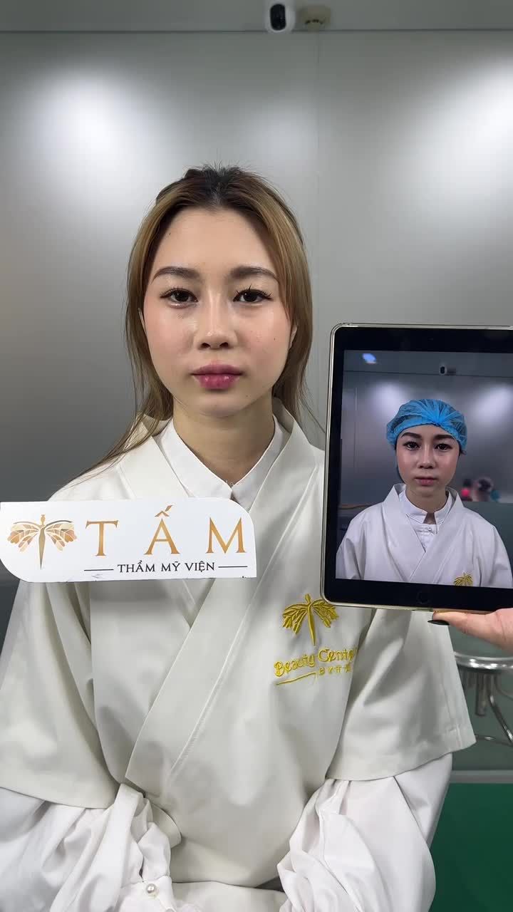 Chi Bé đã quay trở lại Tấm để trải nghiệm dịch vụ Filler môi, cằm. Mời mọi người cùng theo dõi hình ảnh ngay sau làm của Chi nhé.